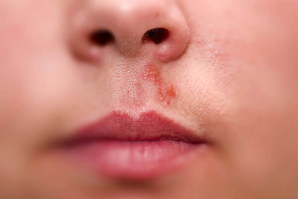 Болячки в носу могут образовываться по разным причинам