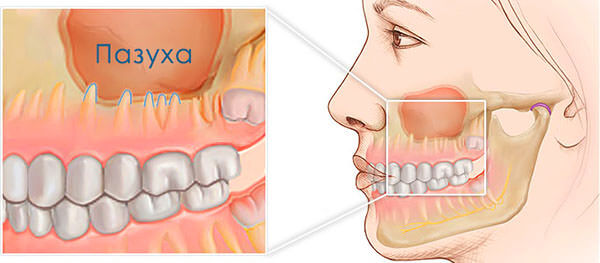 Одна из причин развития гайморита - расположение корней верхних зубов
