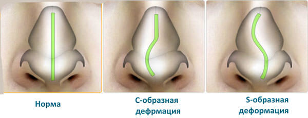 Типы смещения носовой перегородки