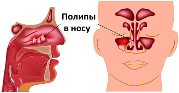 Причиной развития риносинусита могут стать полипы в носу