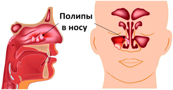 Полипы в носу ребенка могут стать причиной деформации челюсти
