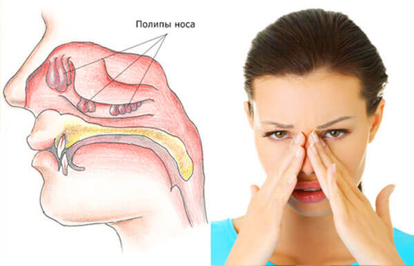 Отсутствие дыхания, постоянная заложенность носа - повод для обращения к доктору