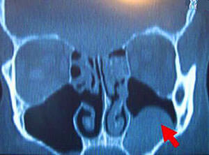 Киста верхнечелюстной пазухи на рентгеновском снимке