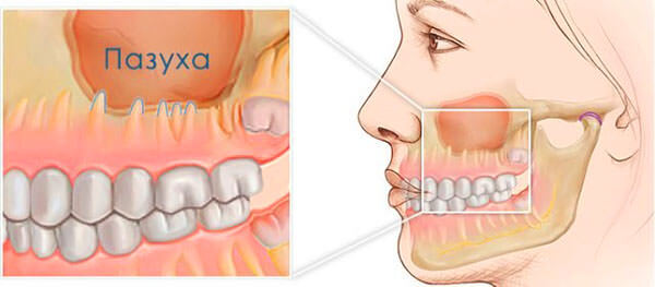 Близкое расположение корней зубов в пазухе - причина развития одонтогенного гайморита