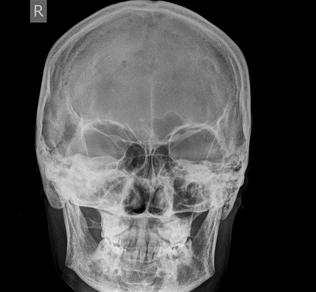 Рентгеновский снимок придаточных пазух носа